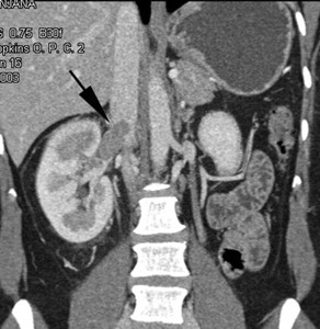 Enlarged Kidney – Kidneypedia